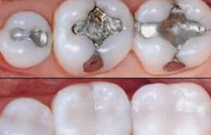 Restauración Dental